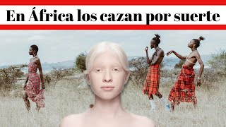 【Albino】¿Por que en África desviven a los Albinos [upl. by Greeson998]