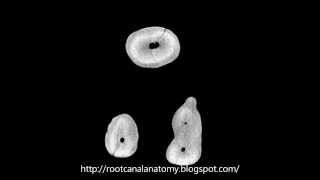 Maxillary First Molar MB2 Prof Marco Versiani [upl. by Iruj148]