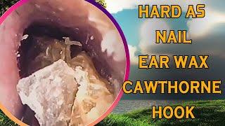 Hard as nails earwax vs cawthorne hook with ear wax removal [upl. by Htial282]