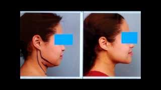 Sculpt the Chin amp Neck With Liposuction  Dr Sterry Explains [upl. by Marena]