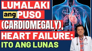 Lumalaki ang Puso Cardiomegaly Heart Failure Ito ang Lunas  By Doc Willie Ong [upl. by Kruse]