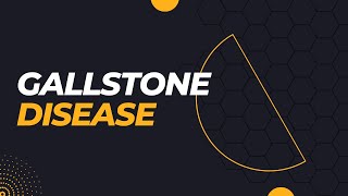 Gallstone Disease Symptoms Causes Diagnosis and Treatment [upl. by Hurd51]