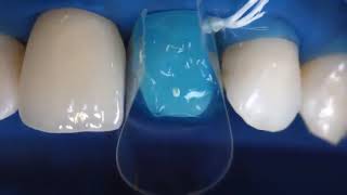 Ivoclar Vivadent Variolink N Kit Resin Cement How To Use  DENTBEAR [upl. by Nallid]