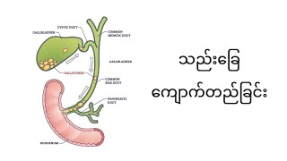 သည်းခြေကျောက်တည်ခြင်း၊ သည်းခြေအိတ်ခွဲစိတ်ခြင်း [upl. by Meriel]