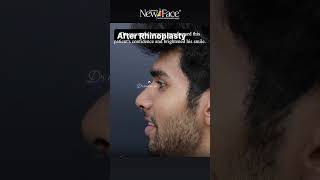 Rhinoplasty Best Results  Dr Mathew PC  Free Onine Consultation  91 8330077198 shorts [upl. by Nylyrehc]