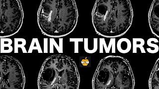 Brain Tumors [upl. by Allecnirp301]