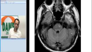 Radiology Spotters by Dr Sumer Sethi 34  Wallerian Degeneration [upl. by Remas519]