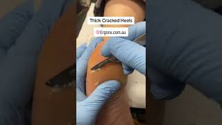 Thick heel callus removal by a podoatrist [upl. by Atirihs]