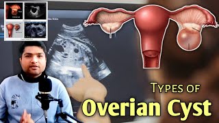 Types of Overian Cyst in Ultrasound by Dr Ali Waqar [upl. by Boyer61]