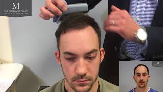 Hair Transplant Results  3464 FUT Grafts  6 months only The Maitland Clinic [upl. by Meerak]