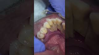 Dental cleaning dental hygiene lyrics musica viral youtubeshorts smile shorts dentist fyp [upl. by Hester]