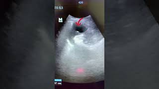 Splenic Cyst Ultrasound ultrasound shortvideo usg3d [upl. by Minier]