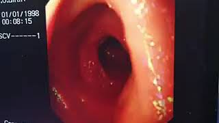 Demonstration of the third and fourth parts of the duodenum using the upper digestive endoscopy [upl. by Maillij]