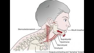 A common cause of TMD Suprahyoid muscle clenching [upl. by Aratal]