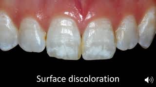 Case Selection for Enamel Microabrasion [upl. by Ferren]