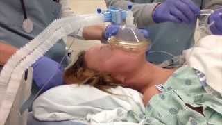 Rapid Sequence Induction with Cricoid Pressure and without Ventilation [upl. by Kacey]