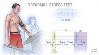 The Cardiac Stress Test  Stress ECG  Stress Echo [upl. by Naasah658]