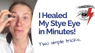 Stye Eye Relief in Just 30 Minutes How I Healed Naturally and Fast [upl. by Etta]