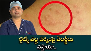 Polymorhous Light Eruption Symptoms and Causes  లైట్స్ వల్ల చర్మంపై ఎలర్జీలు వస్తాయా [upl. by Naitsirc]