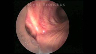 Bronchoscopy for Lung Cancer [upl. by Aia]