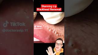 Crazy Painful BLACKHEAD REMOVAL AROUND LIPS  Super Satisfying shorts [upl. by Aivil]