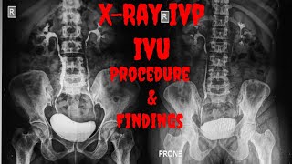 XRAY IVP  XRAY IVU Procedure Indications Findings  Intravenous Urogram  Intravenous Pyelogram [upl. by Ssitruc]