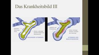 Erklärung des Gendefekts Mukoviszidose [upl. by Demmahom488]