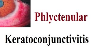 phlyctenular Keratoconjunctivitis [upl. by Anera581]