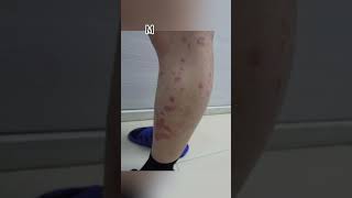 Methods for controlling psoriasis psoriasis [upl. by Brunella238]