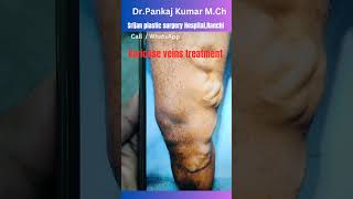 Best varicose veins treatment Laser treatment of varicose veinsvaricose veins treatment in Ranchi [upl. by Ylle]