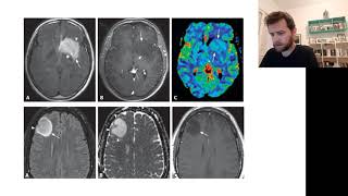 Oligodendroglioma  Resuminho rapidão [upl. by Esor]