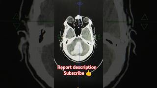 ncct head pathology detail report description radiology anatomy pathology hemantkushwah3453 [upl. by Wagshul]