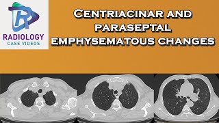 Centriacinar and paraseptal emphysematous changes [upl. by Xaviera]