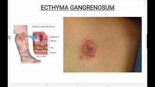 Ecthyma Gangrenosum [upl. by Fabiano]