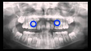 Serial Extraction Panoramic X Ray Time Lapse Kyger Orthodontics [upl. by Juli]