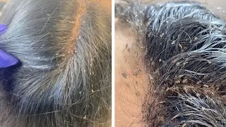 Hair Clinic Remove Hundreds Of Lice From Clients Head [upl. by Enirhtak]