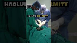 Haglund Deformity Surgery doctor neetmotivation shorts viral [upl. by Defant]