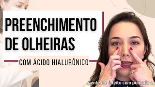 Preenchimento de OLHEIRAS PROFUNDAS com Ácido Hialurônico [upl. by Yursa754]