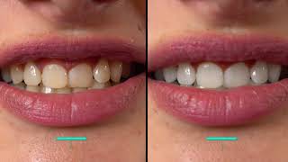 Teeth Whitening Perfekte Zähne mit Bleaching Germany – SHR Germany [upl. by Irahk887]