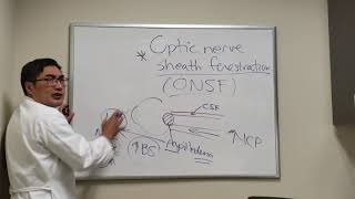 Optic Nerve Sheath Fenestration [upl. by Nathalie]