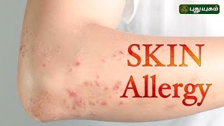 Skin Allergy  Hives  Morning Cafe  06072017  Puthuyugam TV [upl. by Osric]