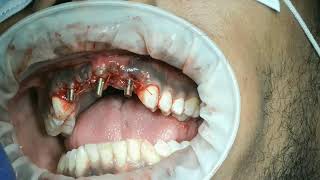 part 1failed apicoectomy upper incisors extraction and 3 single piece implant surgery [upl. by Niehaus]