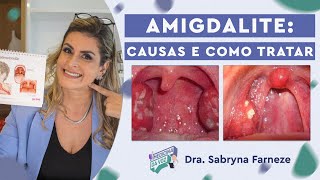 Amigdalite Causas e como tratar [upl. by Magnus]