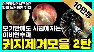 보기만해도 시원해지는 이비인후과 귀지제거모음 2탄 Earwax removal [upl. by Batruk423]