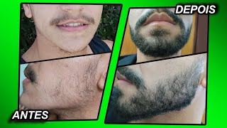 2 ANOS USANDO MINOXIDIL Kirkland e foligain [upl. by Neelyad]