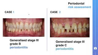 Symposium on stage IIII periodontitis treatment guideline  Yaman Altaep from Liège [upl. by Rella]