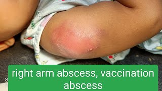 vaccination abscess [upl. by Aysab]