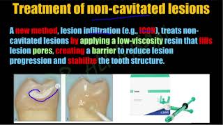 caries activity prevention treatment amp minimal invasive caries removal methods  operative 4 Lec5 [upl. by Deaner722]