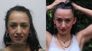 Hairloss in women Hair Transplant women with 1800 Grafts [upl. by Lsil897]