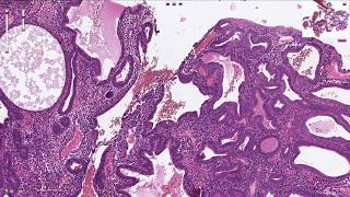 Endometrial Hyperplasia  Histopathology [upl. by Earehs603]